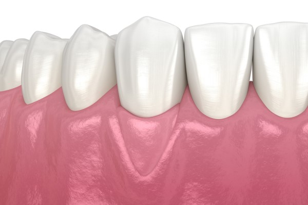 Reasons For A Gum Graft Procedure