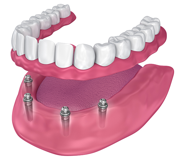 All-on-4 Dental Implants