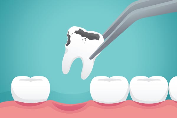 Ask A General Dentist: What Happens To Your Tooth After Extraction