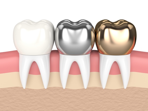 How Dental Crowns Can Restore Your Teeth