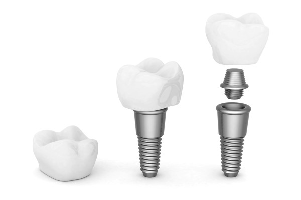Three Signs You Might Need A Dental Implant Restoration