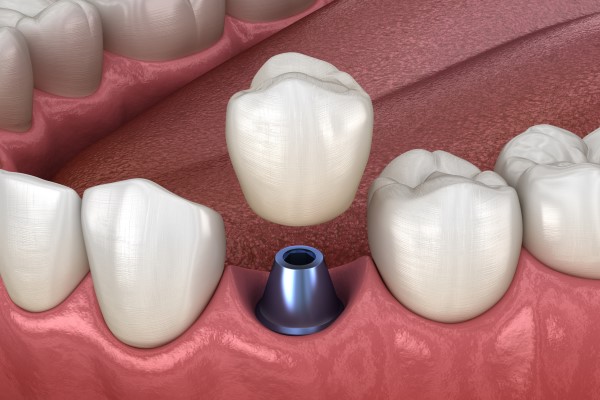 How Easy Is It To Replace An Implant Crown?