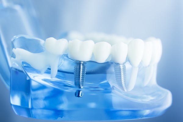 Questions To Ask At Your Dental Implants Consultation