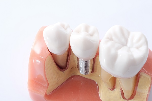 implant Crowns