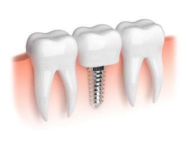 Implant Dentist