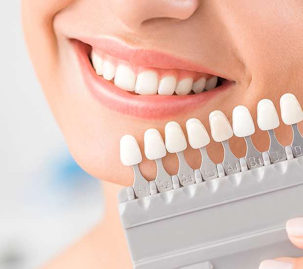 Albuquerque Dental Veneers and Dental Laminates