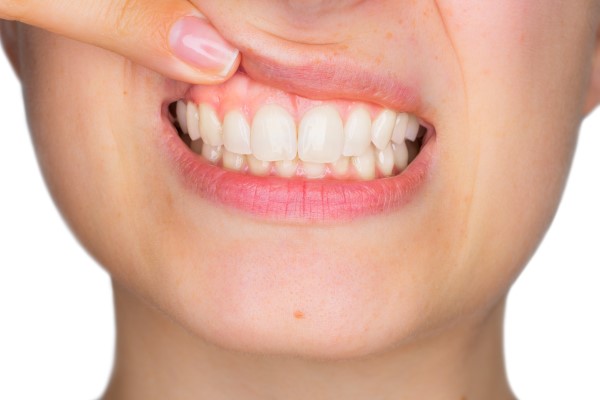 Gum Contouring Treatment Can Help With A Gummy Smile