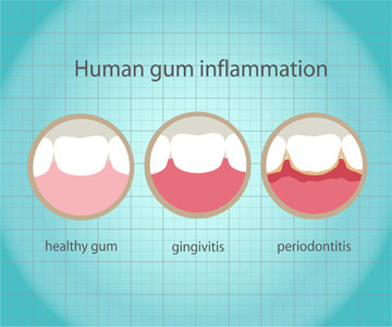 Surgical And Non Surgical Gum Disease Treatments