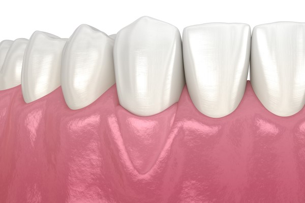 What Is Involved In A Gum Graft Procedure?