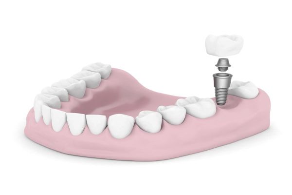 Implant Dentist