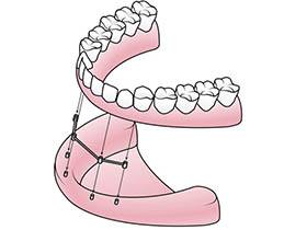 Implant Supported Dentures