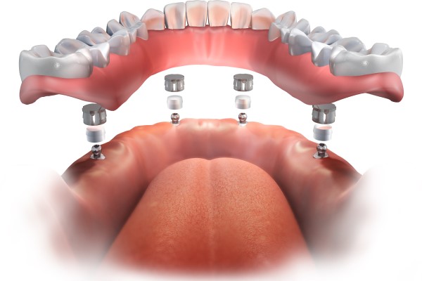 Replacing Missing Teeth With Implant Dentures