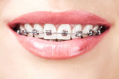Are You Familiar With Removable Orthodontics?