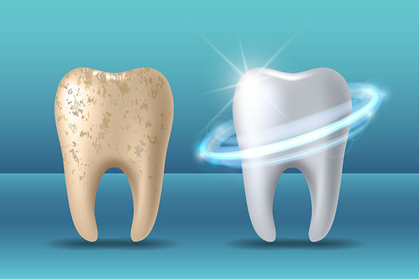 Pros And Cons Of Teeth Whitening Treatments