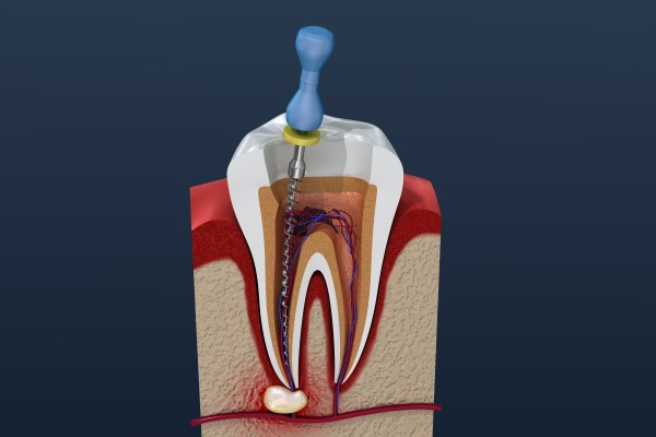 What Can Happen If You Avoid A Root Canal Treatment