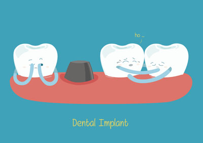 Dental Implants