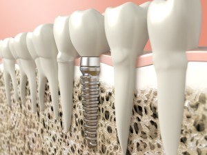 Implant Dentist in Albuquerque
