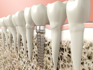 Implant Dentist in Albuquerque Implant Dentist in Albuquerque