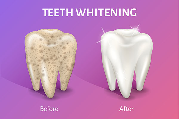 Side Effects of Teeth Whitening Treatments from Roderick A. Garcia, DMD PC in Albuquerque, NM