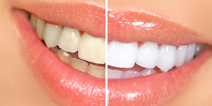 Teeth Whitening in Columbus, Ohio - Murray Hill Dental