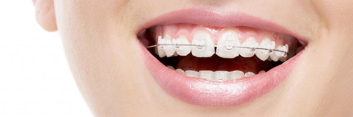 Albuquerque Types of Braces