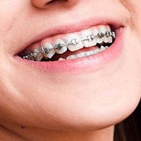 Types of Braces